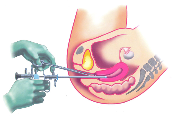 Маточное выскабливание. Полип эндометрия гистероскопия. Гистероскопия с выскабливанием. Раздельное выскабливание полости матки.